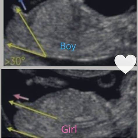 مراحل تطور الجنين خلال الثلث الثاني من الحمل 5