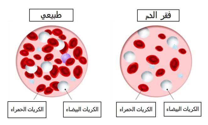 10 أعراض فقر الدم وعلاجها