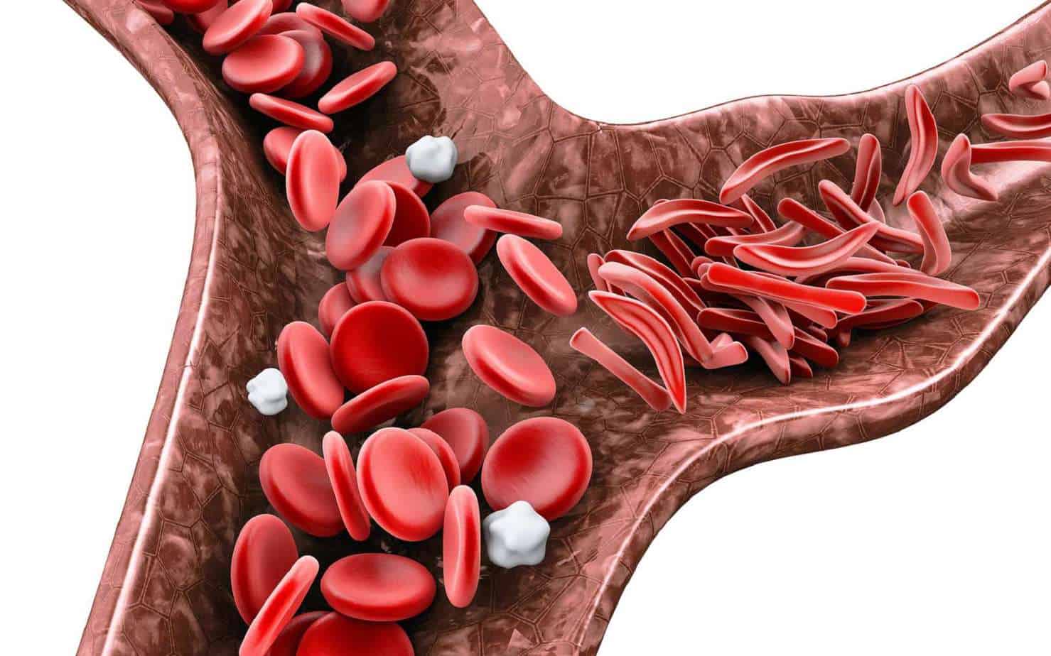 10 أعراض فقر الدم و علاجها