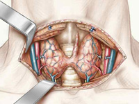 العلاج الجراحي لأمراض الغدة الدرقية